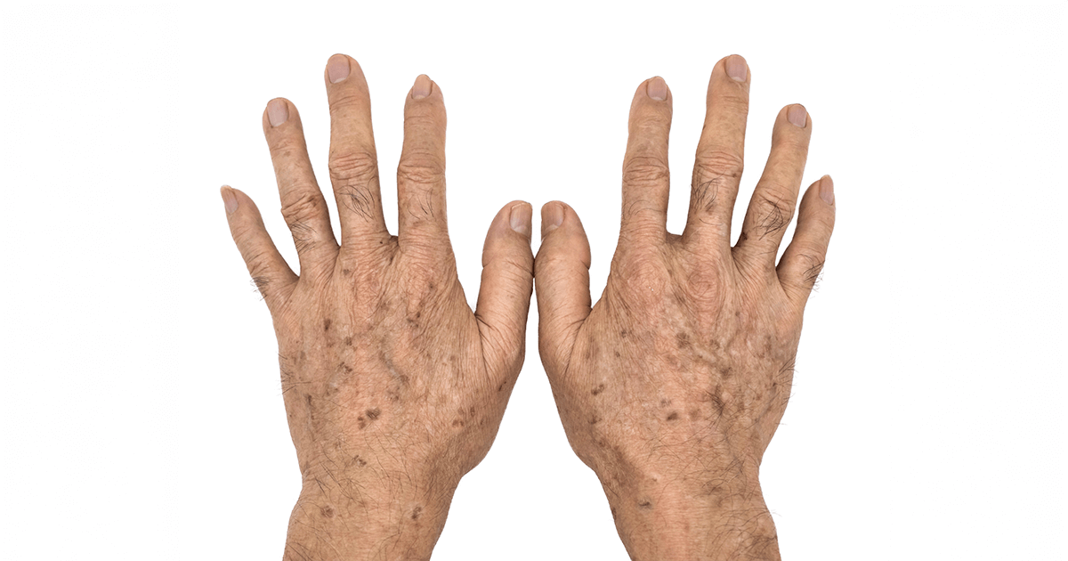 How Do Liver Spots Look?